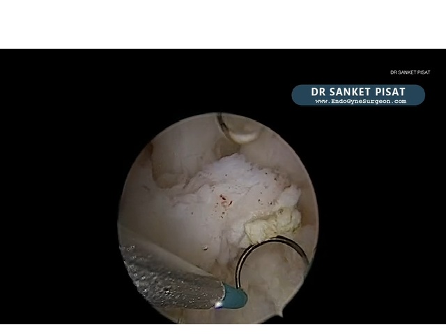 Hysteroscopic Adenomyoma Resection (NL0067)