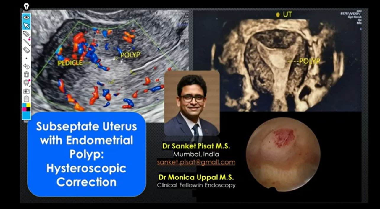 Subseptate Uterus + Polyp