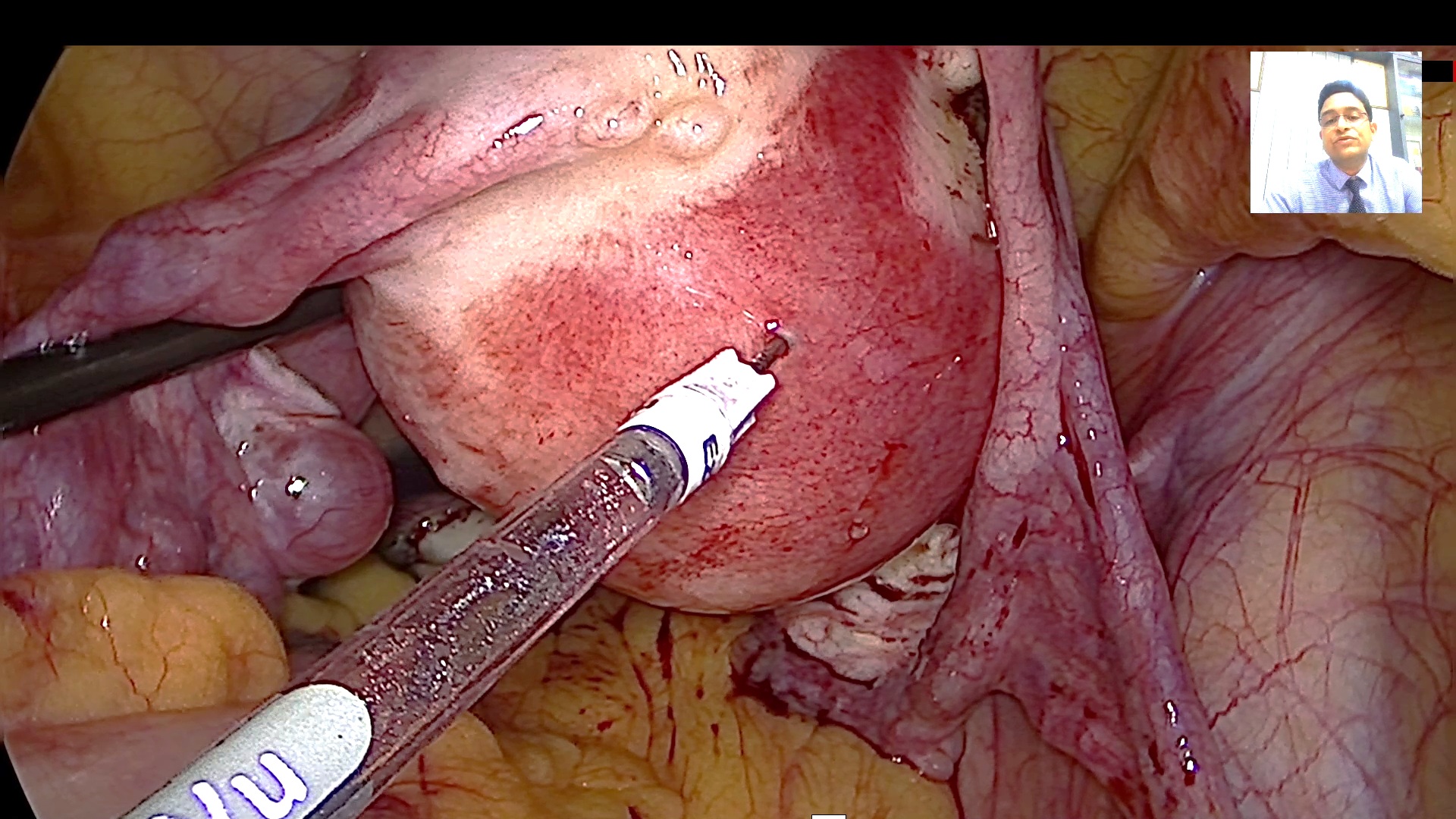 Multiple Myomas - Fertility Enhancing Surgery (CL0003)