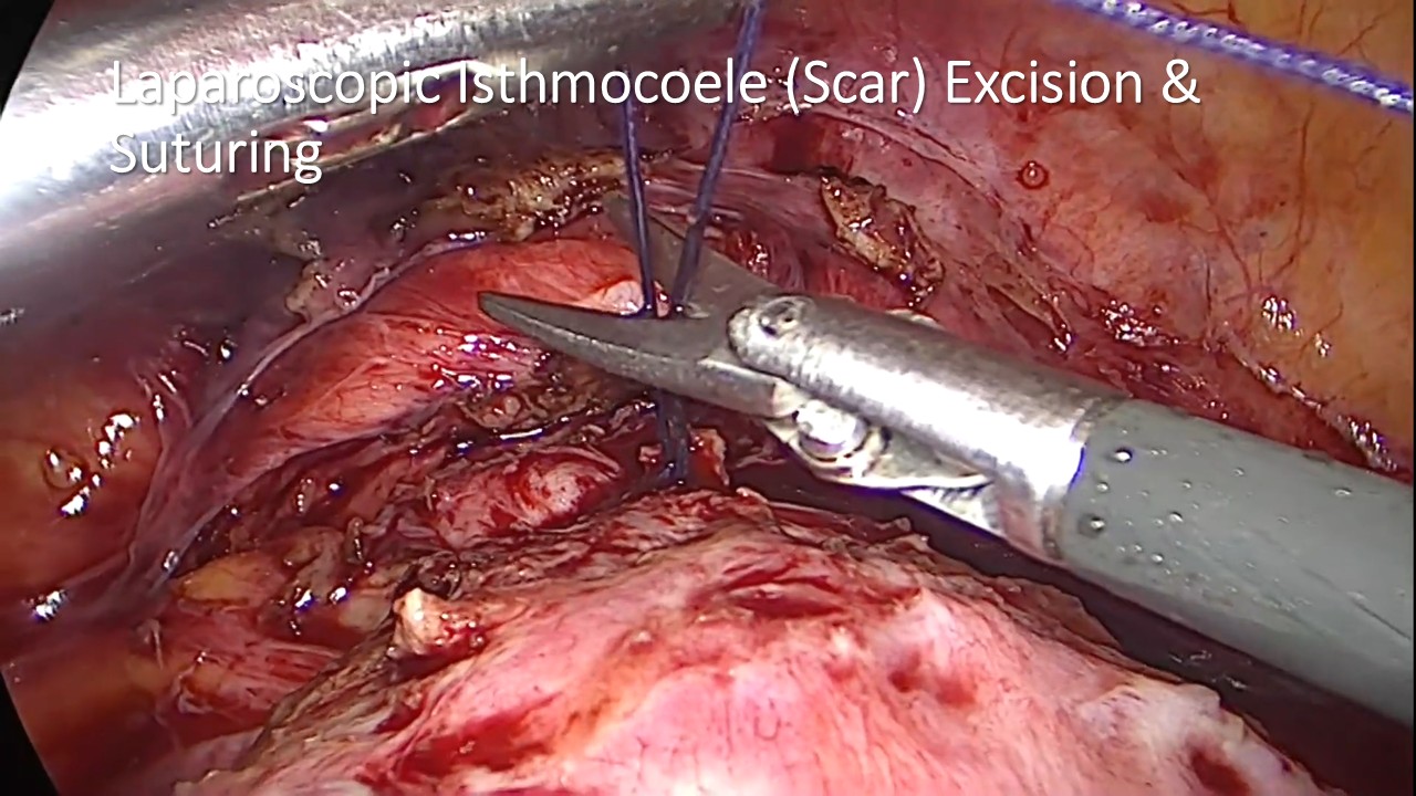 Laproscopic Isthmocoele (Niche) Repair (NL0034)