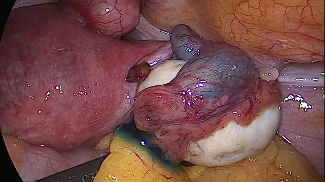 Diagnostic HL scopy + Small Myomectomy Without Morcellator (NL0020)