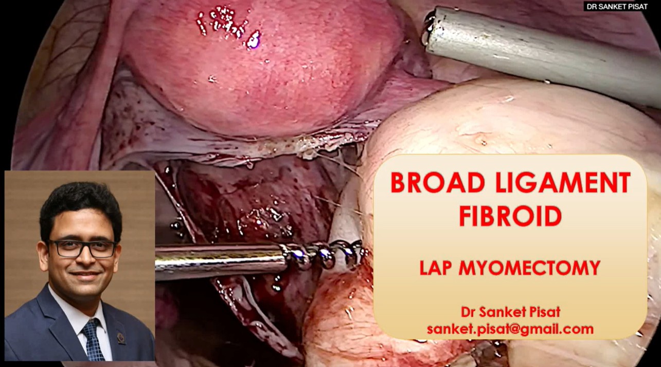 Lap Myomectomy Broad Ligament Fibroid