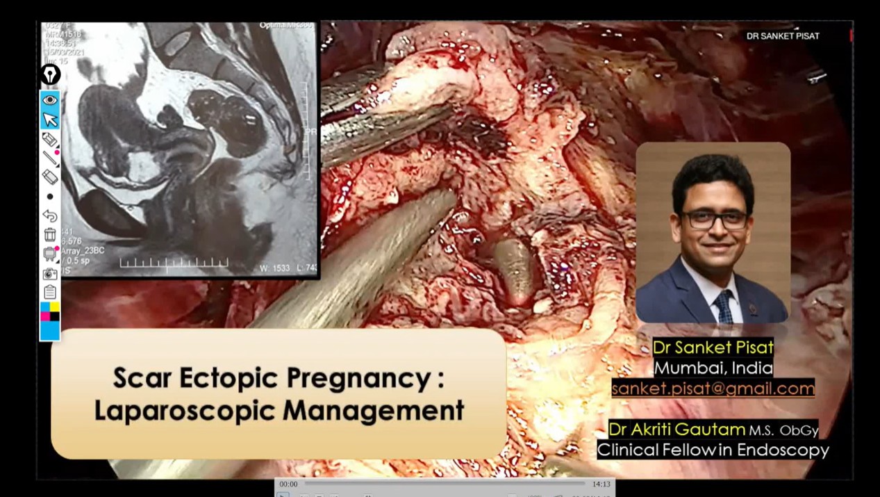 Laparoscopic Management of Scar Ectopic