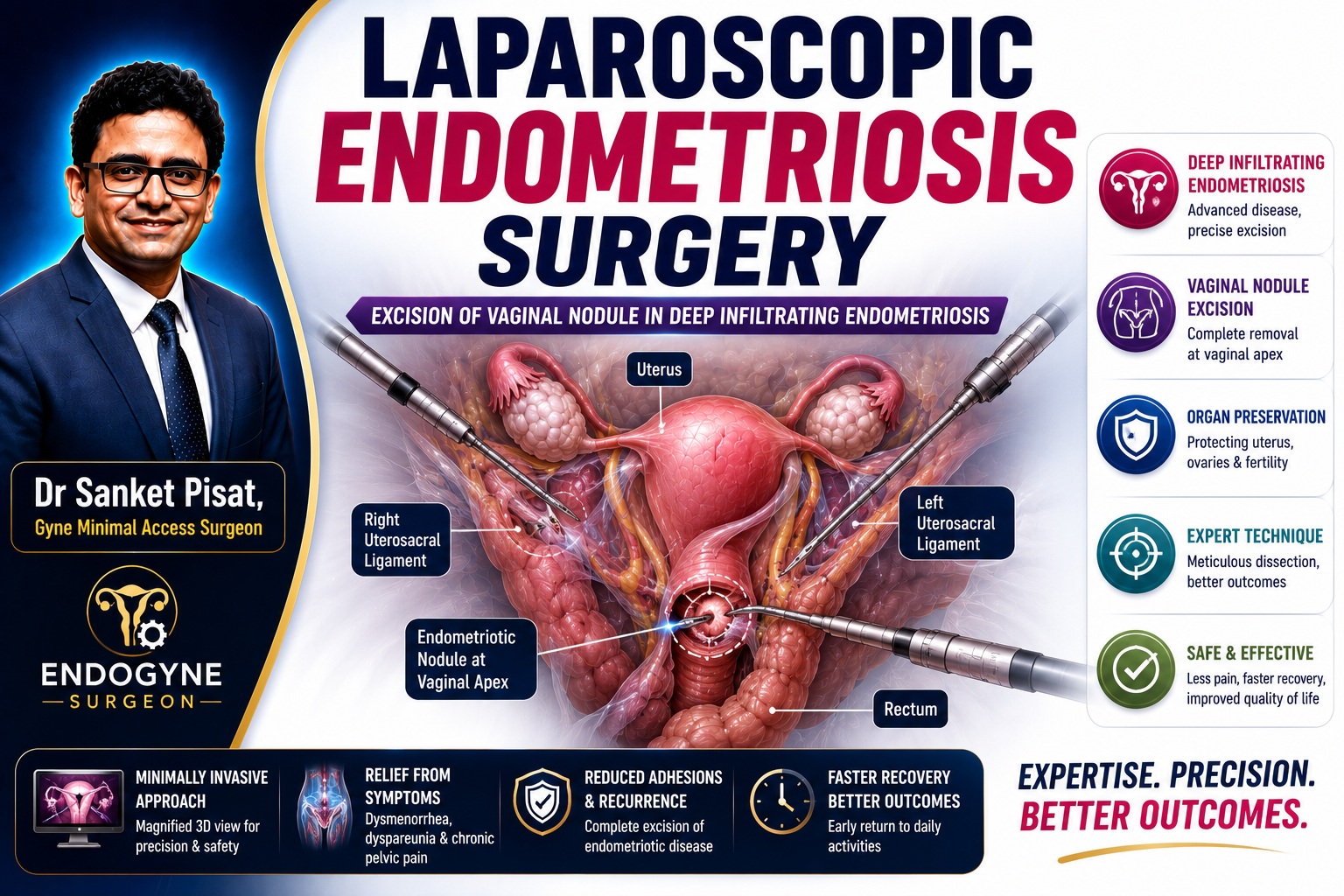 Laparoscopic Excision of vaginal Endometriotic Nodule in Deep Infiltrating Endometriosis