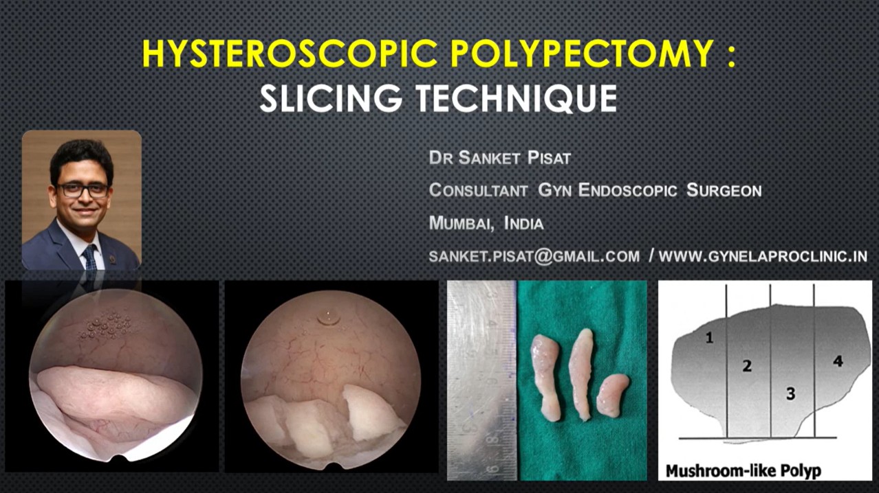 Hysteroscopic Polypectomy Slicing Technique & Submucous Fibroid (SS0008)