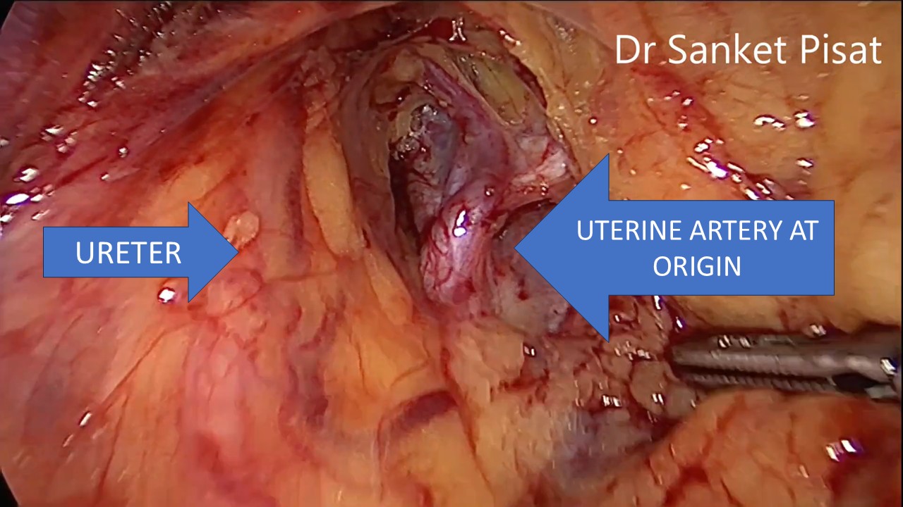 TLH with post surgical bowel adhesions and UAL at origin (hysterectomy) (uterine artery ligation) (NL0004)