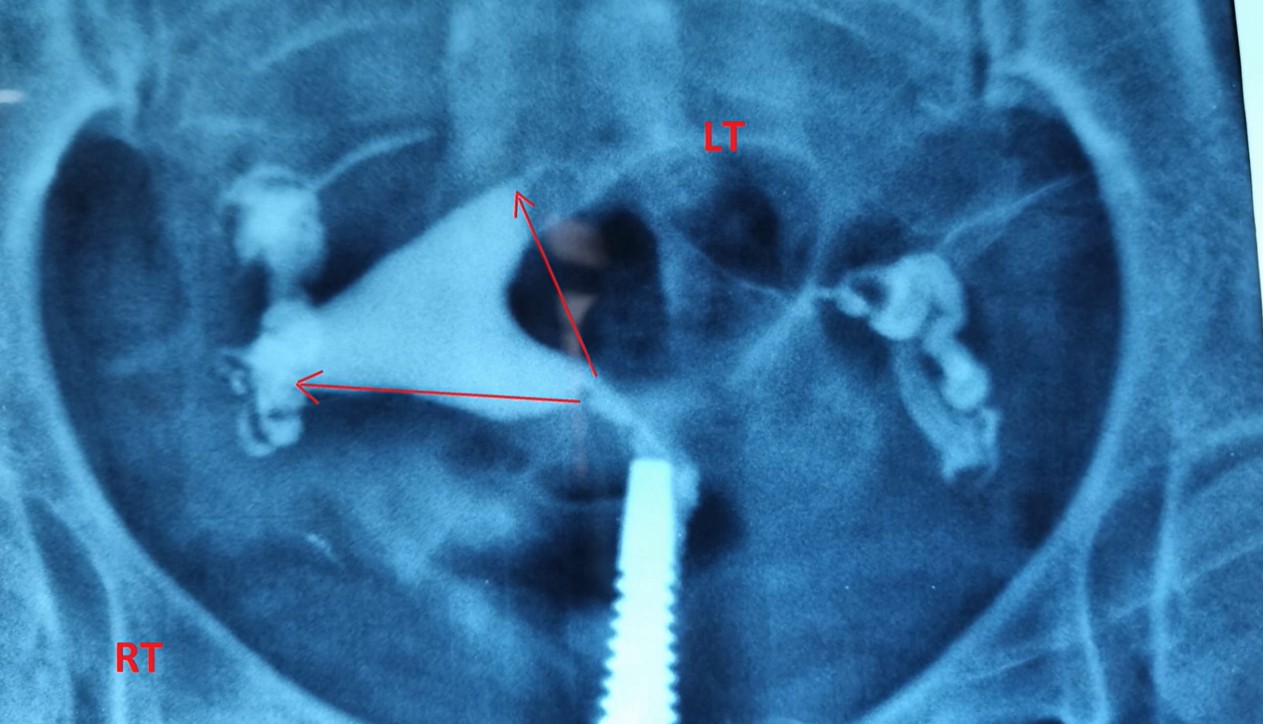 Hysteroscopic Lateral Metroplasty
