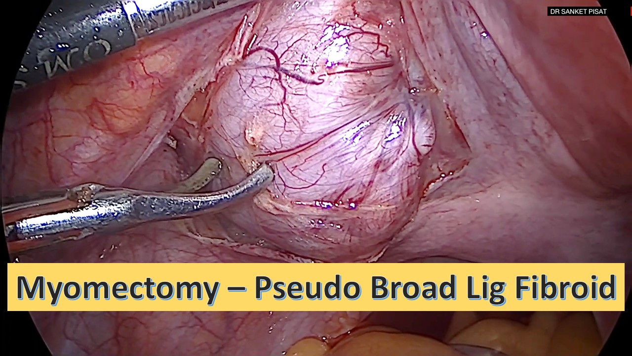 Lap Myomectomy - Pseudo Broad Ligament Fibroid (NL0002)