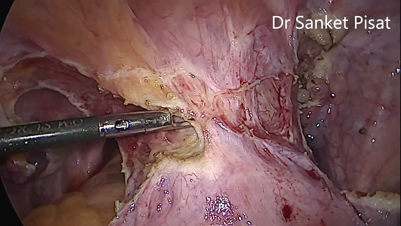 TLH for Previous 3 LSCS with bladder dissection (hysterectomy) (NL0011)
