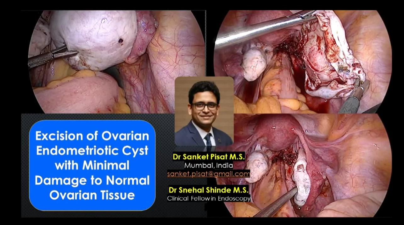 Laparoscopic Excision of Ovarian Endometriotic Cyst with Minimal Damage to Ovarian Tissue