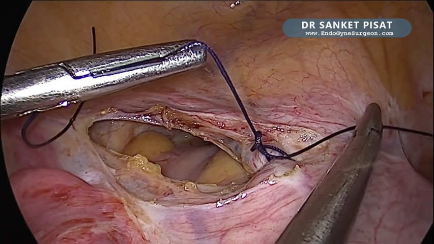 Laparoscopic Myomectomy + Uterine Artery Ligation + In Bag Morcellation