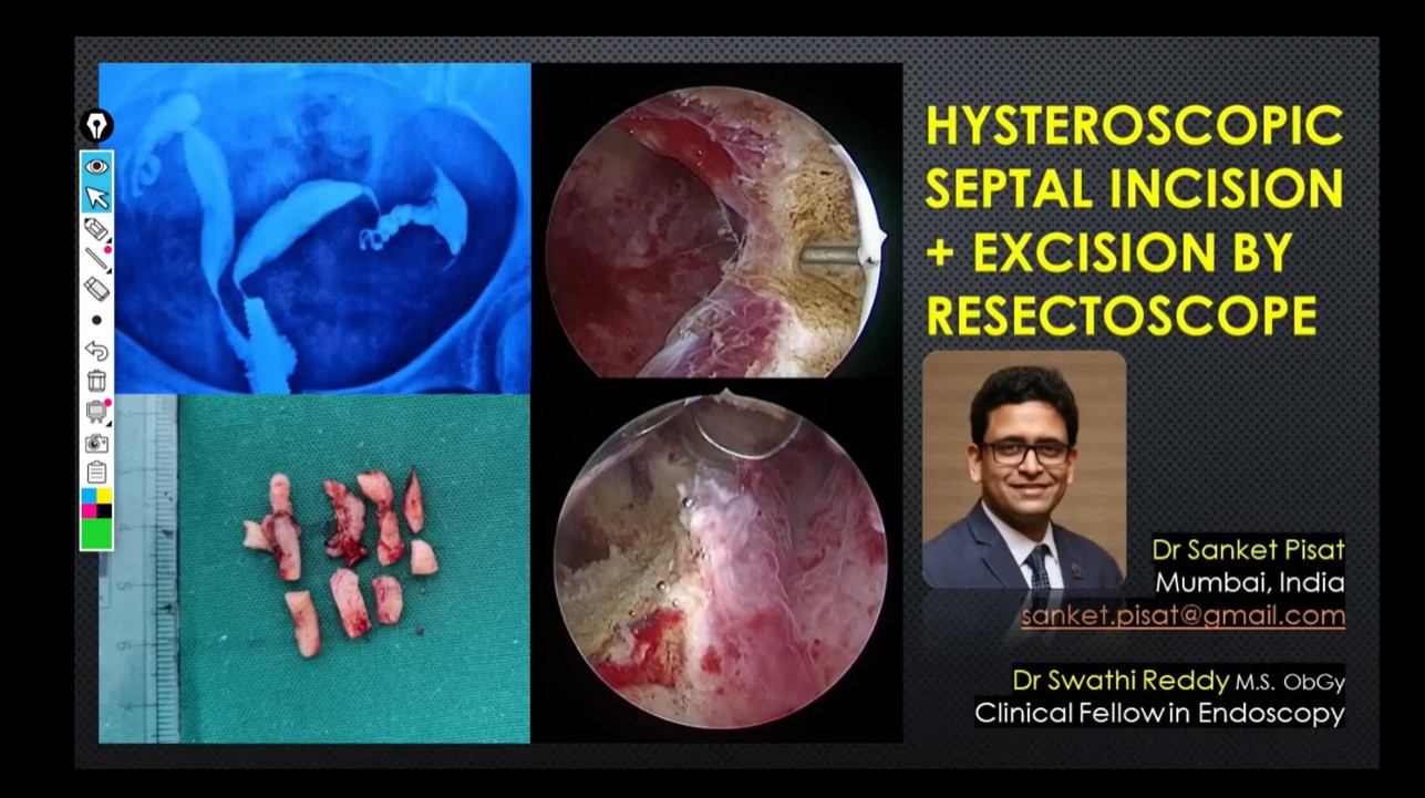 Hysteroscopic Septum Resection Bipolar Resectoscope