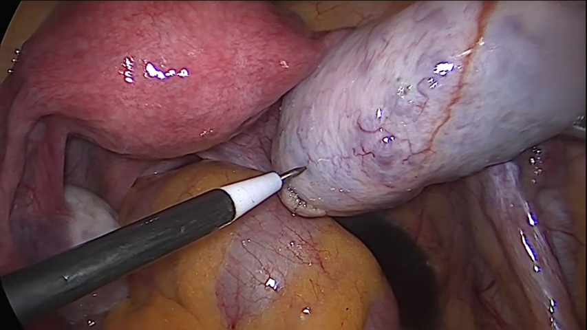 PCO drilling + Diagnostic Hysteroscopy (NL0014)