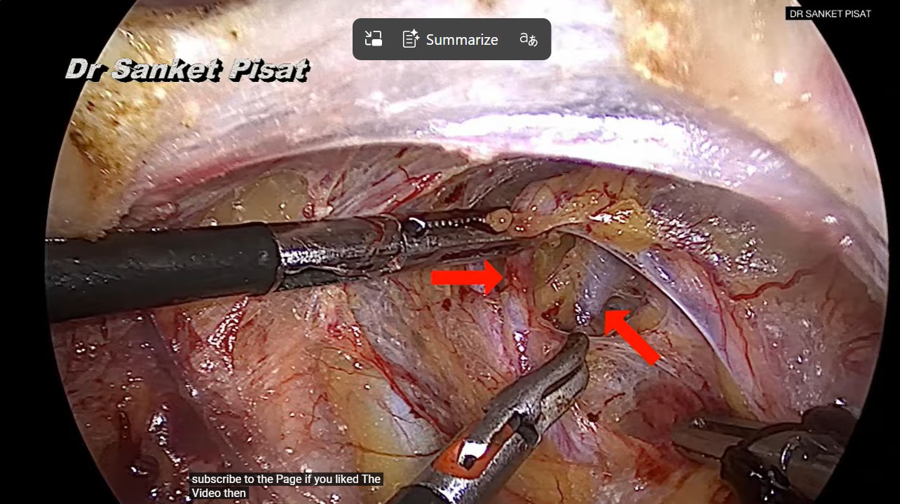 Laparoscopic Uterine Artery Ligation (SS0026)