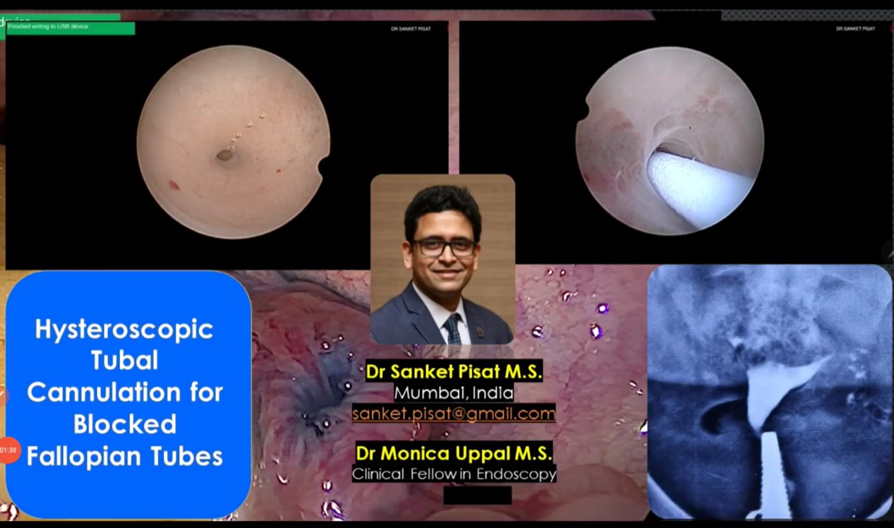 Tubal Block Hysteroscopic Cannulation