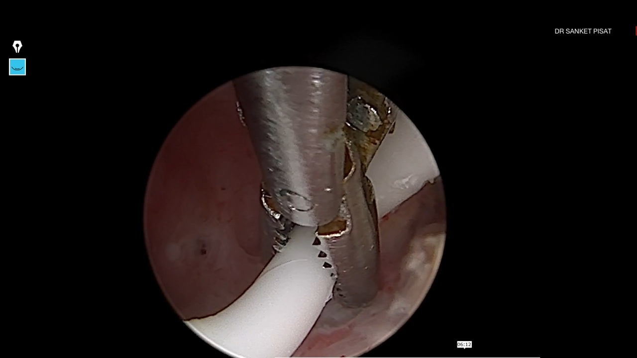 Hysteroscopic Removal - Forgotten IUCD (NL0021)