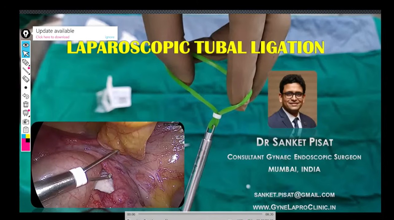 Laparoscopic Tubal Ligation