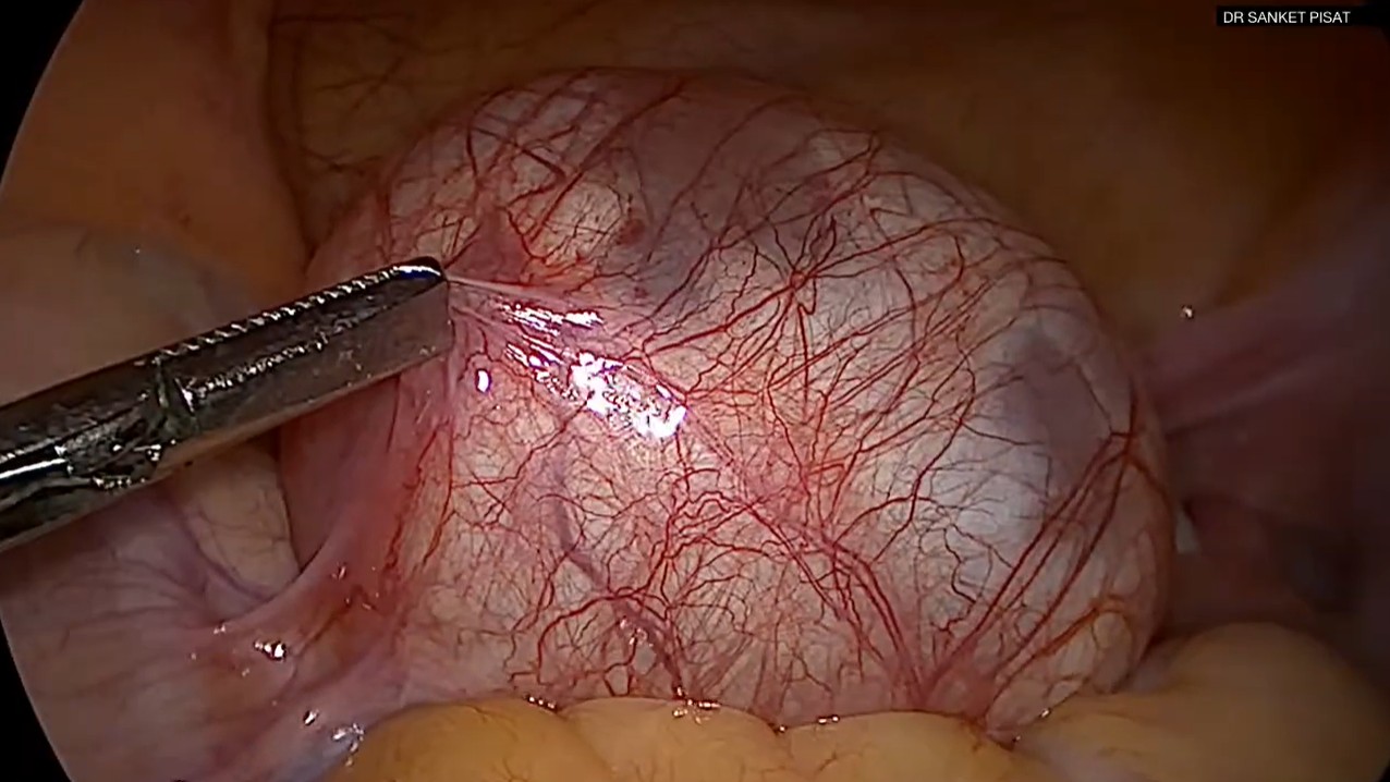 Laparoscopic Management of Para Ovarian Cyst