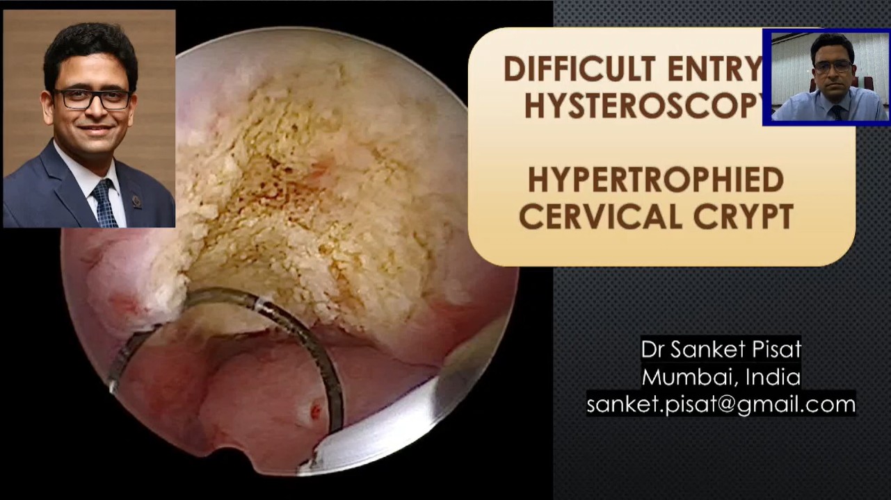 Difficult Hysteroscopy Entry Hypertrophied Crypt