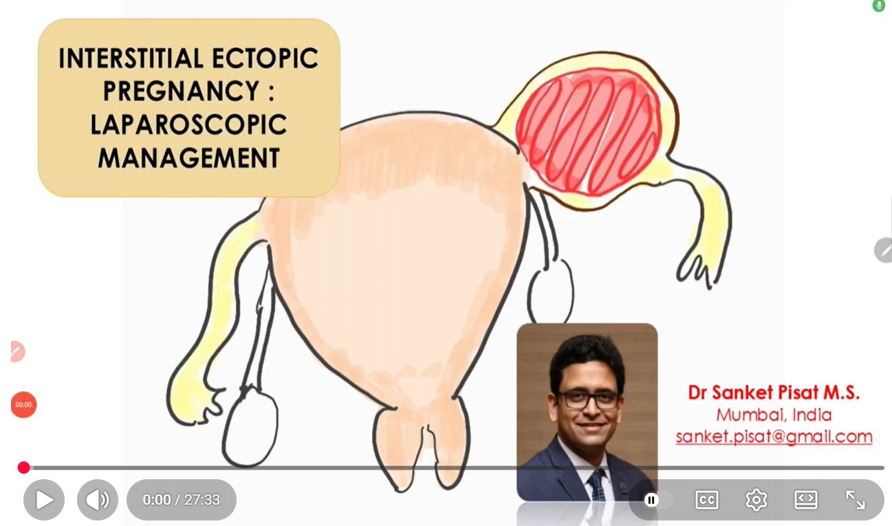 Laparoscopic Management of Interstitial/ Cornual Ectopic Pregnancy (SS0048)