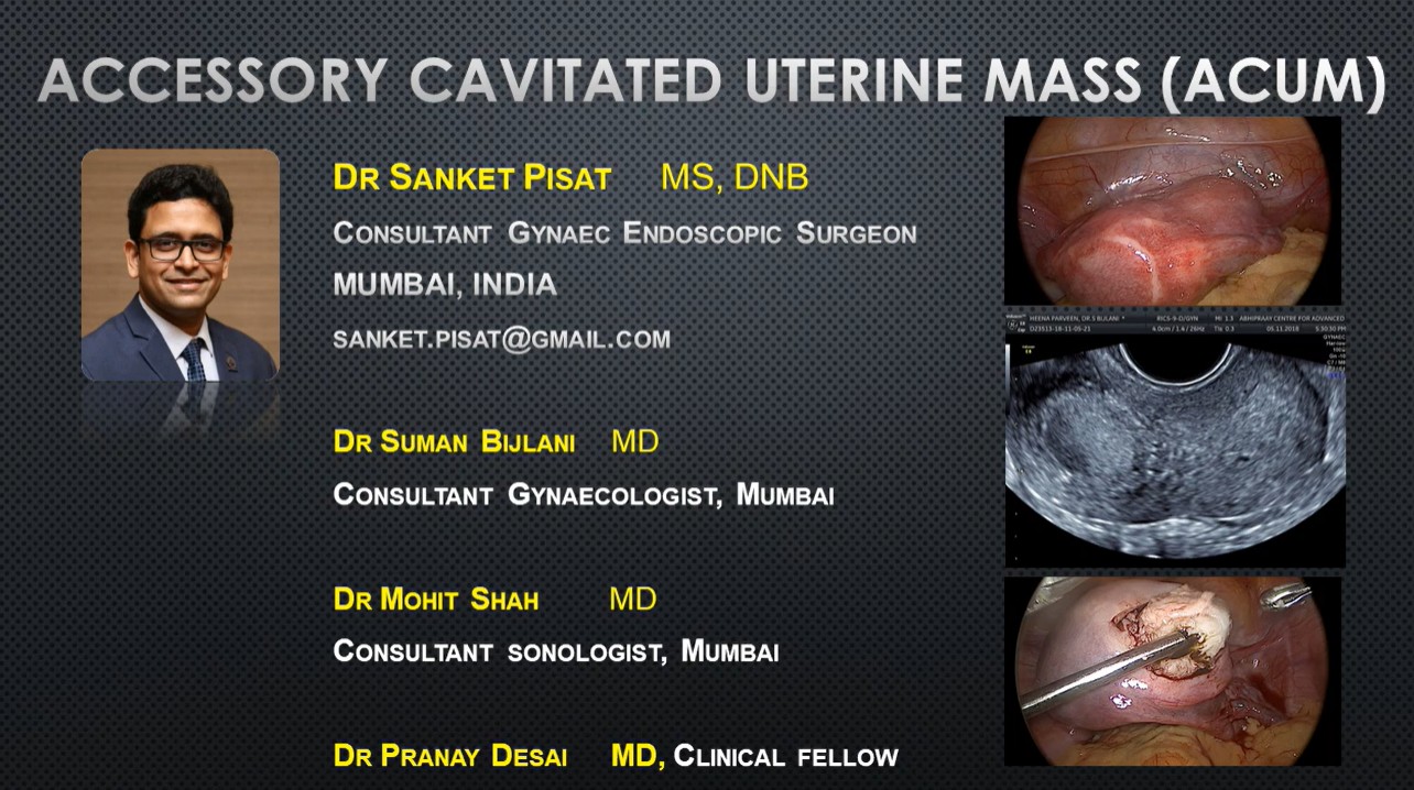 Laparoscopic Management of Accessory Cavitated Uterine Mass (ACUM)