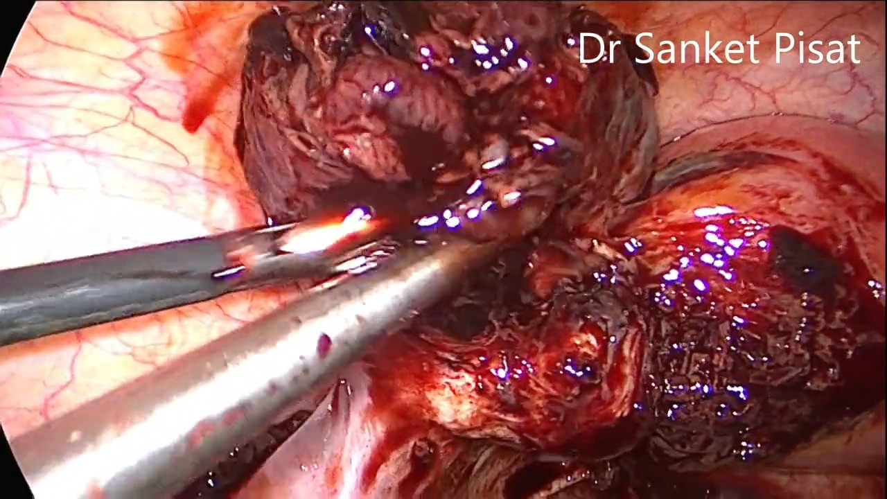 Chronic Ectopic - Laparoscopic Salpingectomy (NL0006)