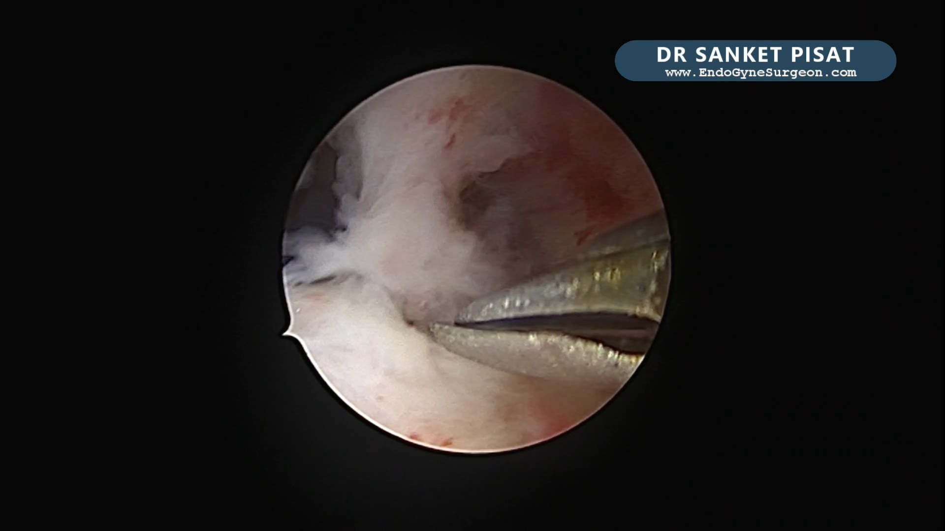 Hysteroscopic Synechiolysis + Polypectomy (NL0053)