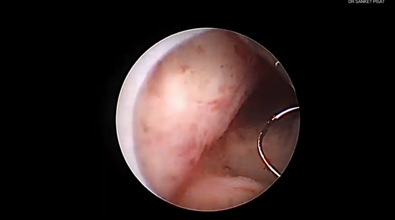 Hysteroscopic Fibroid Polyp Resection (SS0006)