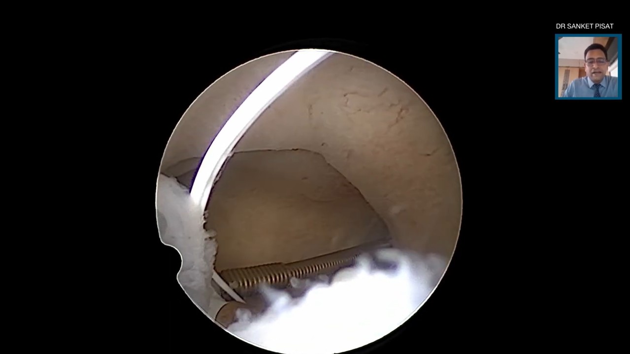 Hysteroscopic Copper T (IUCD) Removal