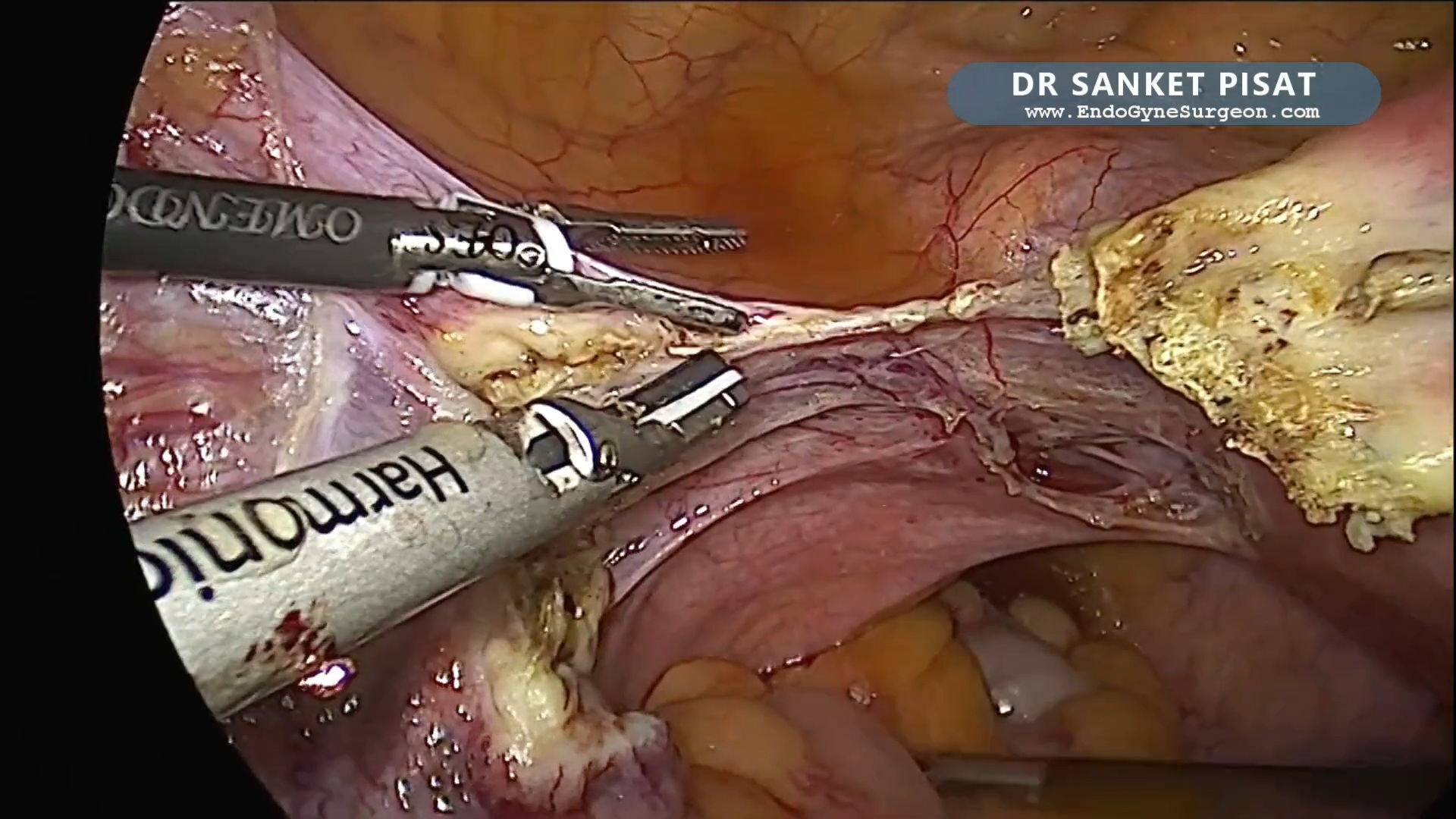 TLH - Harmonic Scalpel (NL0054)
