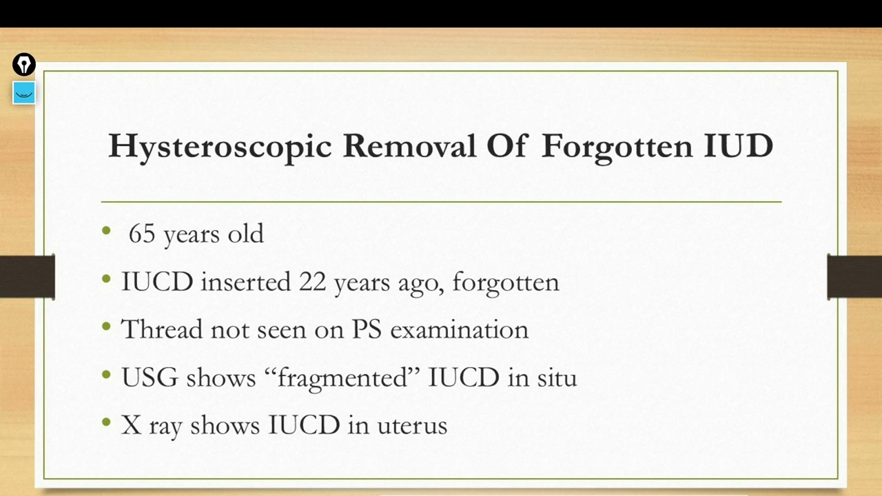 Hysteroscopic IUCD Removal (NL0031)