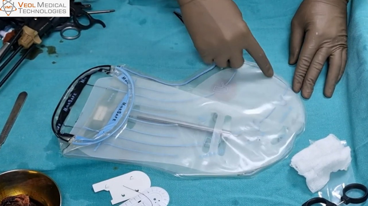 Contained Morcellation of Fibroids using Morsafe Bag