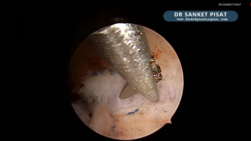Hysteroscopic Septal Incision + Diagnostic Laparoscopy