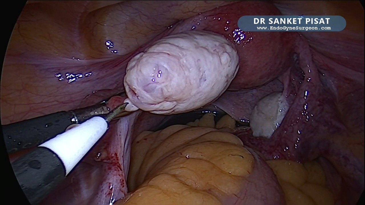 Laparoscopic Non Electrical Ovarian Drilling + Hysteroscopic Polypectomy (NL0043)