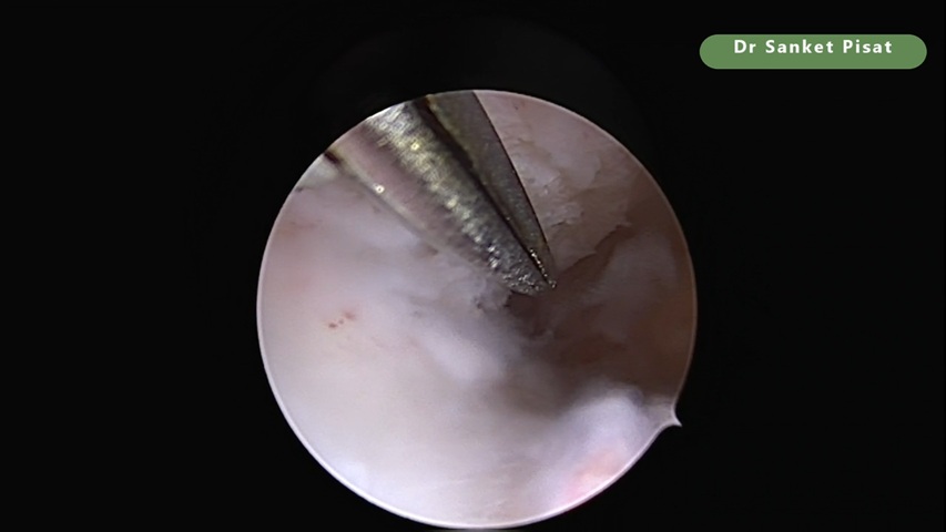 Hysteroscopic Lateral Metroplasty (NL0026)