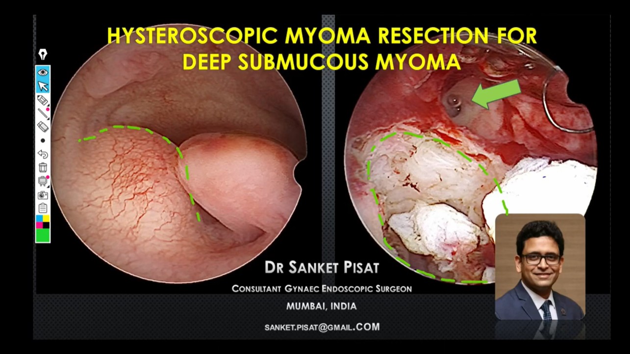 Hysteroscopic resection of deep submucous myoma