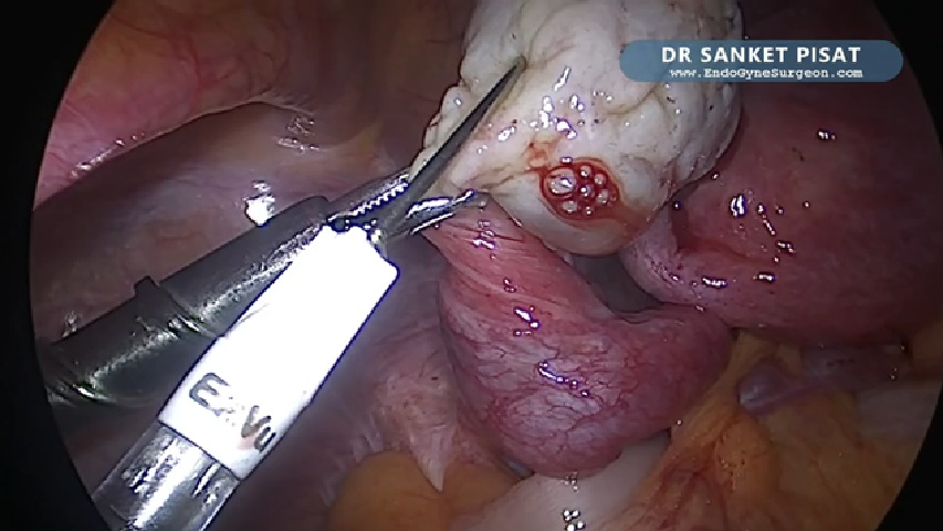 Intra Ovarian PRP Injection + Hysteroscopic Septum + Lat Metroplasty (NL0051)