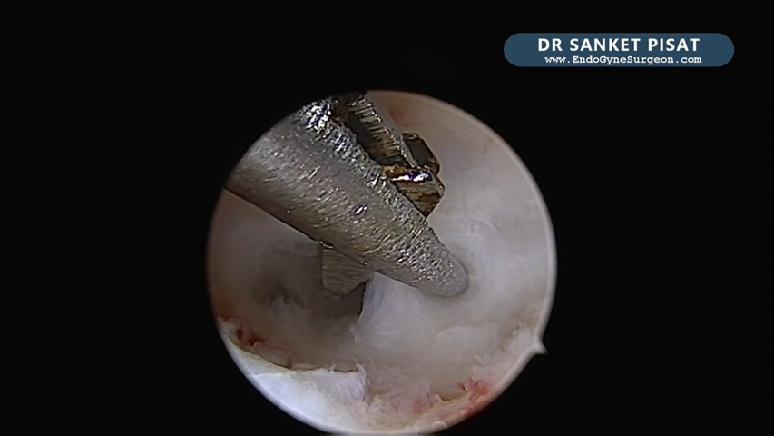 Hysteroscopic Synechiolysis (Asherman's) + Sub Endometrial PRP (NL0042)