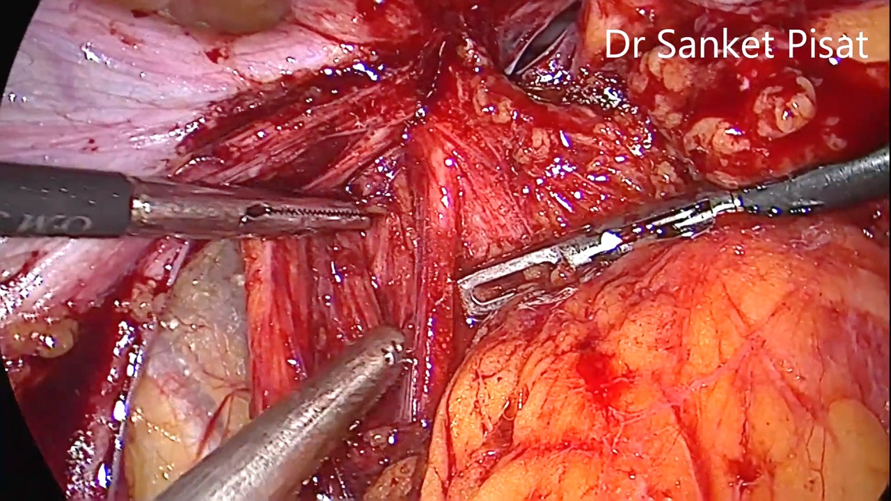 TLH for Grade 4 Endometriosis - Frozen Pelvis (Hysterectomy) (NL0003)