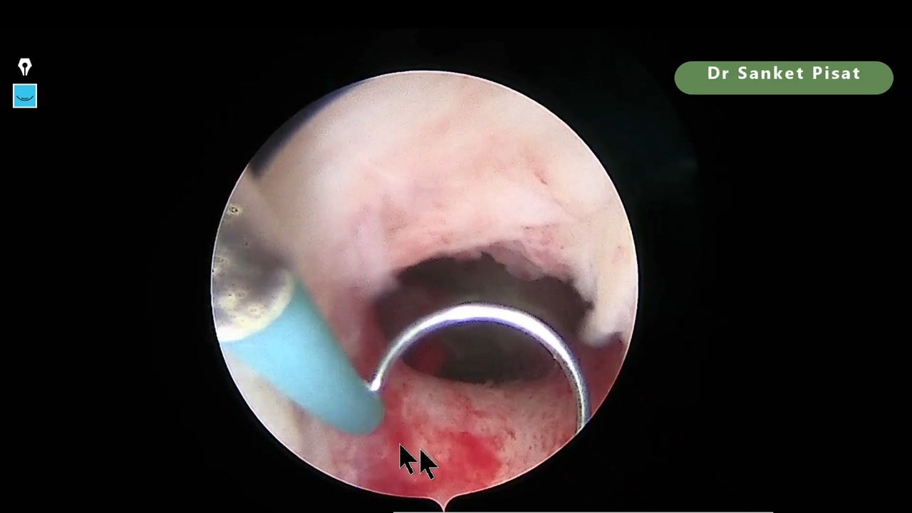 Hysteroscopy - Cervical Stenosis - Failed ET (SS0076)