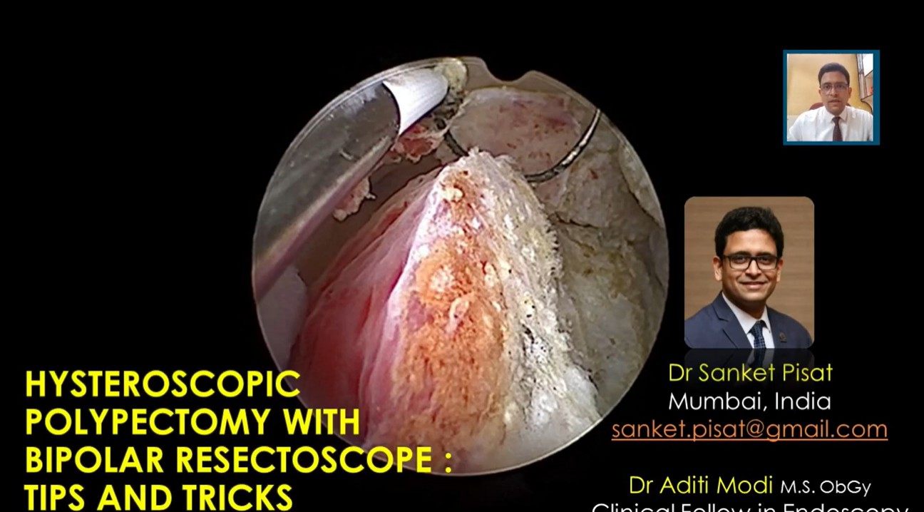 Hysteroscopic Polypectomy with Bipolar Resectoscope