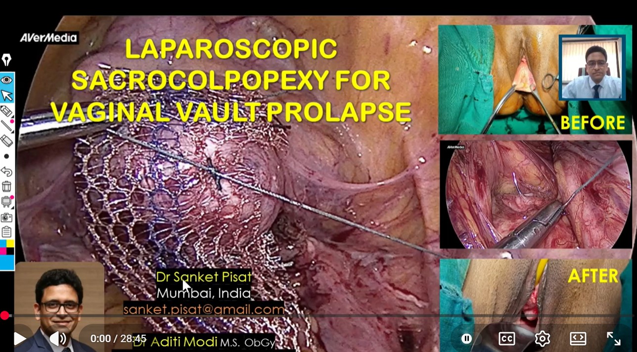 Laparoscopic Vault Prolapse Sacropexy