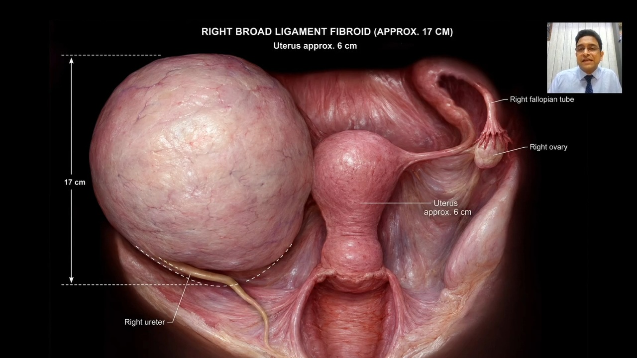 Massive Broad Ligament Fibroid: Open Hysterectomy