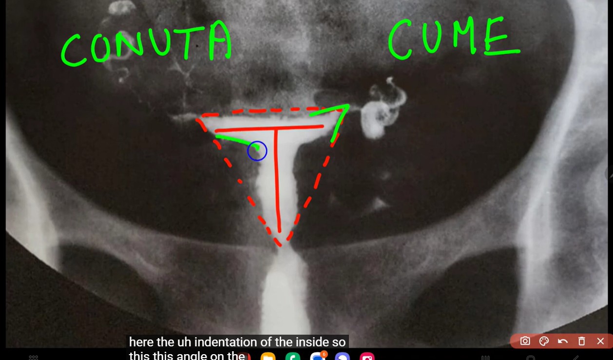 Hysteroscopic Lateral Metroplasty for Narrow T Shaped Uterus using Resectoscope (SS0073)
