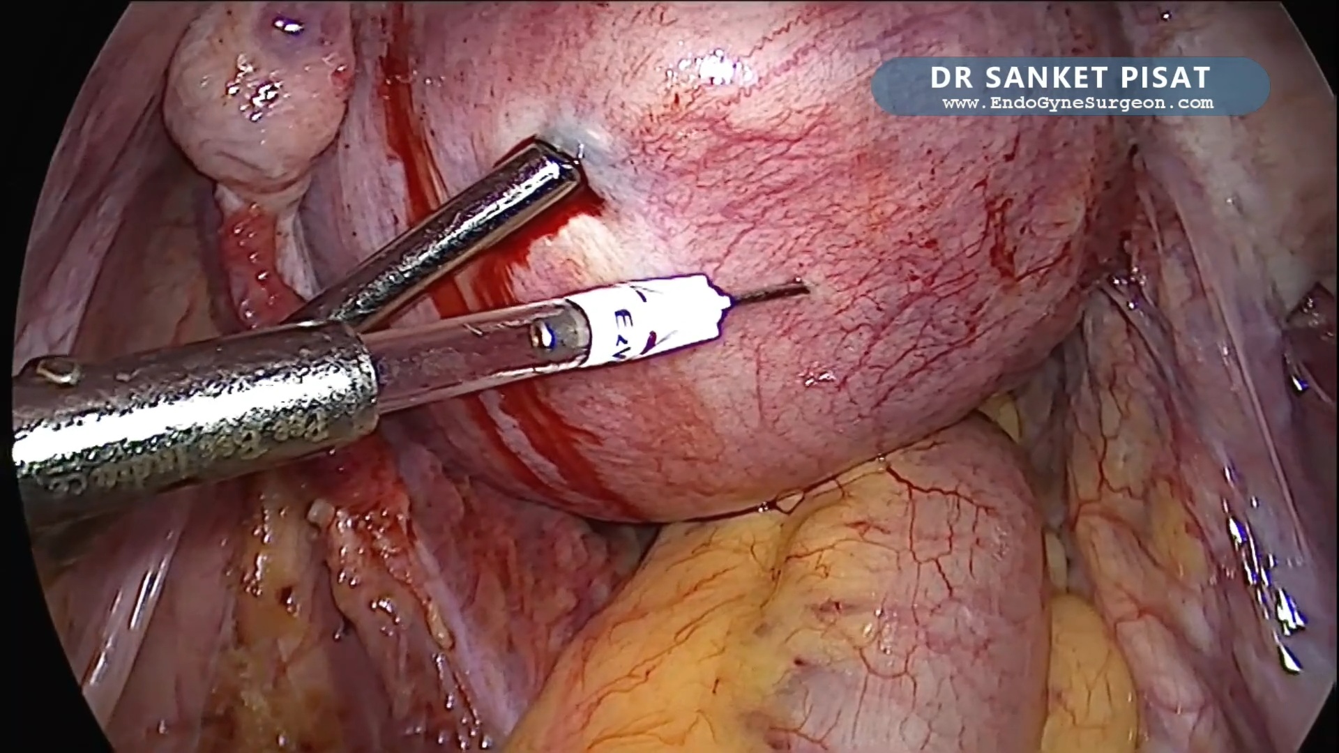 Cervical Fibroid - UAL at Origin + In Bag Morcellation (NL0056)
