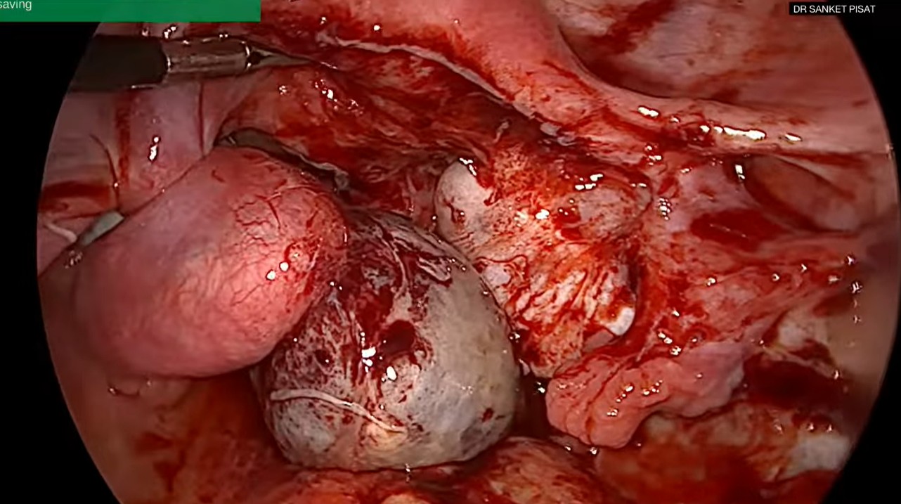Laparoscopic Mangament of Ovarian Torsion