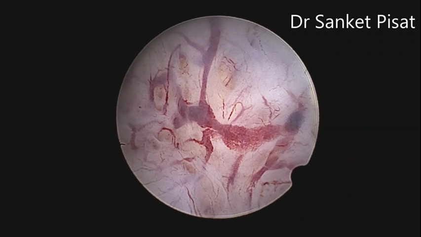 Diagnostic Hystero - Endometrial Hyperplasia (NL0015)