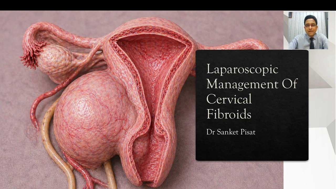 CL02 Lap Management Of Cervical Fibroids