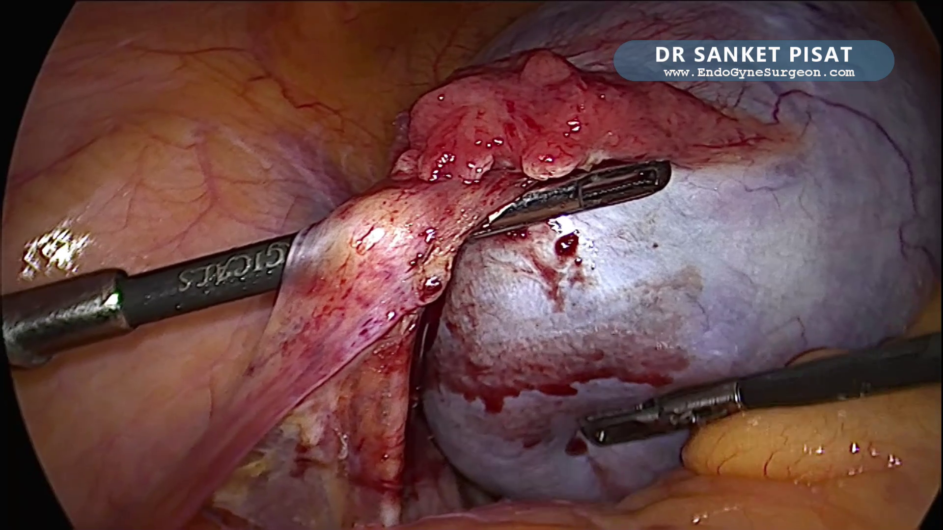 Lap Oophorectomy - Complex Ovarian Mucinous Cystadenoma (NL0041)